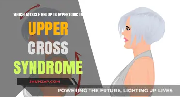 Hypertonic Muscles in Upper Cross Syndrome: Identifying the Key Groups