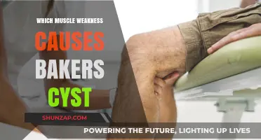 Muscle Weakness Linked to Baker's Cyst: Understanding the Connection