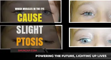 Understanding Ptosis: Key Eye Muscles Responsible for Drooping Eyelids