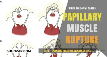 Papillary Muscle Rupture: Identifying the Culprit Type of Myocardial Infarction