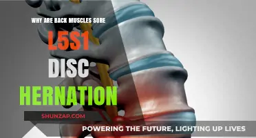 L5-S1 Disc Herniation: Understanding Back Muscle Soreness and Relief