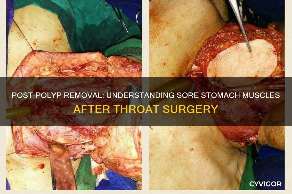 why ate stomache muscles sore after throat polyps removed
