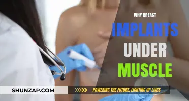 Breast Implants: Under Muscle, Safer and More Natural