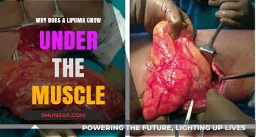 Understanding Lipoma Growth: Why They Develop Beneath Muscle Tissue