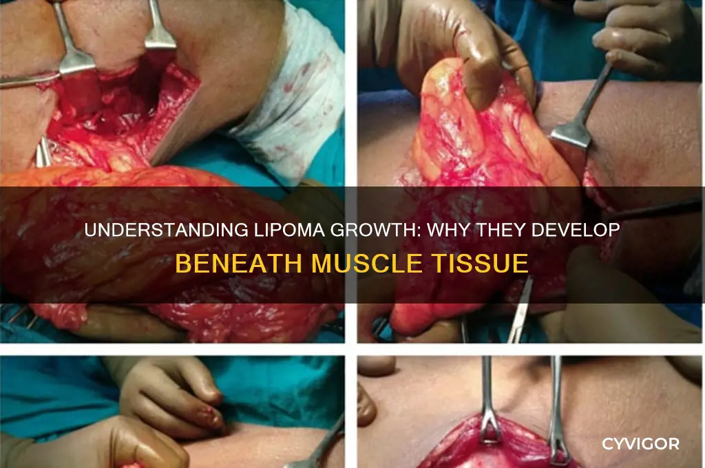 why does a lipoma grow under the muscle
