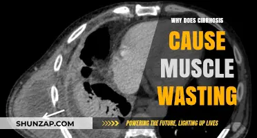 Cirrhosis and Muscle Wasting: Unraveling the Link to Weakness