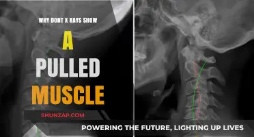 Why X-Rays Can't Detect Pulled Muscles: Understanding Imaging Limits