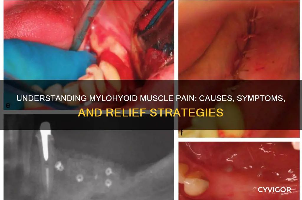 why is my mylohyoid muscle pain
