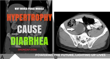 Psoas Muscle Hypertrophy and Diarrhea: Unraveling the Unexpected Connection