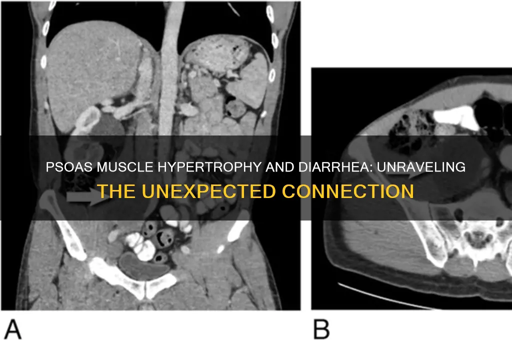 why would psoas muscle hypertrophy cause diarrhea