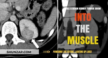 Can a Benign Kidney Tumor Spread to Muscle Tissue?