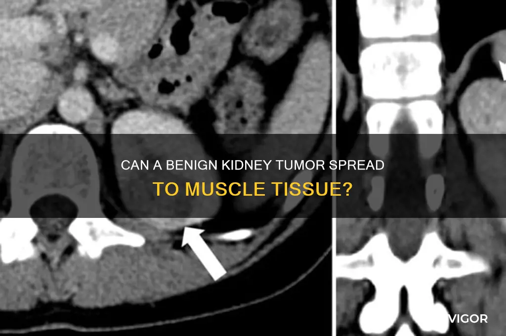 will a beign kidney tumor grow into the muscle