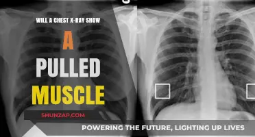 Can Chest X-Rays Detect Pulled Muscles? Understanding Imaging Limits