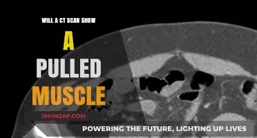 Can a CT Scan Detect a Pulled Muscle? The Truth Revealed