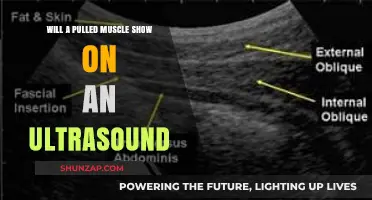 Can Ultrasound Detect Pulled Muscles? Imaging Insights Revealed