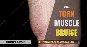 How Torn Muscles Cause Bruising and Swelling