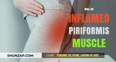 Piriformis Syndrome: Inflammation and Treatment Options