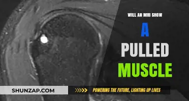 Can an MRI Detect a Pulled Muscle? What to Expect