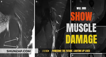 MRI for Muscle Damage: What You Need to Know
