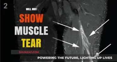 MRI for Muscle Tears: What to Expect