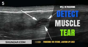 Ultrasound: Effective Tool for Detecting Muscle Tears
