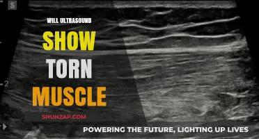 Ultrasound Imaging: Effective for Diagnosing Torn Muscles?