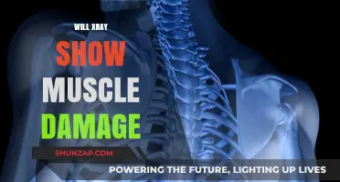 X-ray Vision: Can It See Muscle Damage?