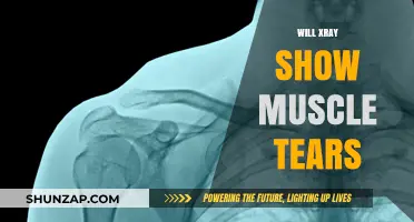 X-ray Limitations: Muscle Tears and More