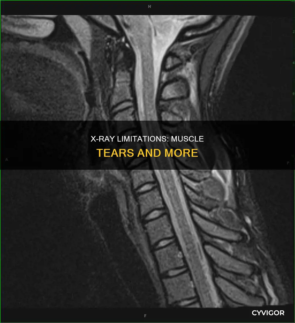 will xray show muscle tears