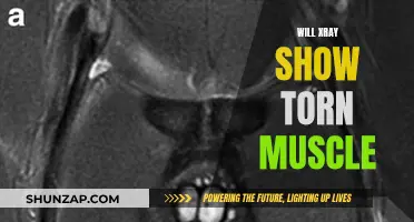 X-ray Imaging: Effective for Torn Muscle Diagnosis?