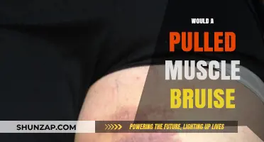 Can a Pulled Muscle Cause Bruising? Facts and Insights