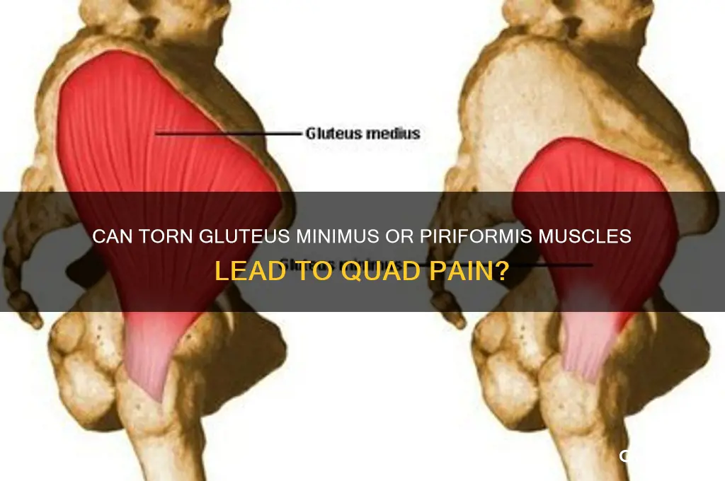 would torn gluteus minmus piriformis muscles cause quad pain